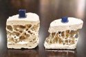 骨密度测量仪测出骨质疏松怎么办