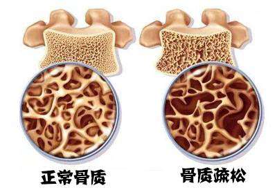 骨密度仪如何测试骨密度,特殊人群如何面对骨质疏松？